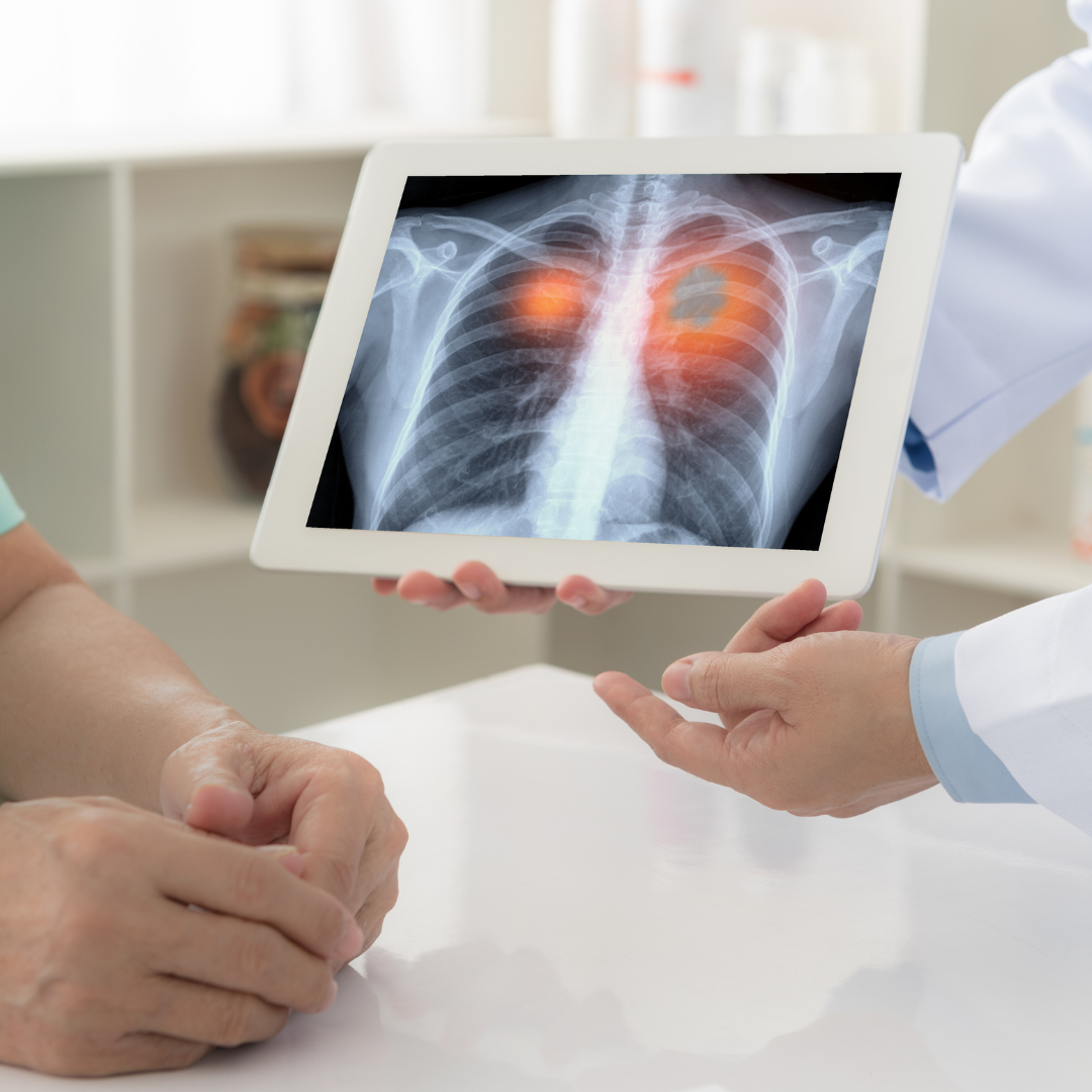 A Look at Common Myths About Lung Cancer Treatment